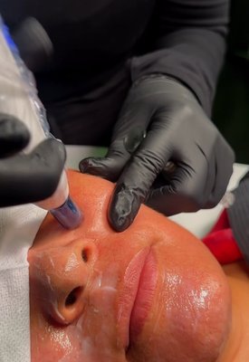 Microneedling Salmon Sperm Facial - NEW! Microneedling Salmon Sperm Facial – The Secret to Radiant, Rejuvenated Skin
Discover the next generation of skin rejuvenation! Our exclusive Microneedling Salmon Sperm Facial combines the collagen-boosting power of microneedling with the incredible regenerative properties of polynucleotides (PN) derived from salmon DNA – a cutting-edge skincare ingredient taking the beauty world by storm.
This treatment is designed to:
✅ Stimulate deep cellular repair
✅ Improve skin texture, tone, and elasticity
✅ Minimize fine lines, acne scars, and pigmentation
✅ Leave your skin glowing, hydrated, and firm
Why salmon sperm? It may sound surprising, but it’s packed with DNA-rich polynucleotides that promote natural skin healing and renewal—making it a powerhouse for anti-aging and deep hydration.
Perfect for those looking to restore youthful radiance, even out skin tone, or prep for a big event!
Limited introductory pricing available – Call now to book your transformation!
Spaces are limited and your skin will thank you. Microneedling Salmon Sperm Facial - NEW! Microneedling Salmon Sperm Facial – The Secret to Radiant, Rejuvenated Skin
Discover the next generation of skin rejuvenation! Our exclusive Microneedling Salmon Sperm Facial combines the collagen-boosting power of microneedling with the incredible regenerative properties of polynucleotides (PN) derived from salmon DNA – a cutting-edge skincare ingredient taking the beauty world by storm.
This treatment is designed to:
✅ Stimulate deep cellular repair
✅ Improve skin texture, tone, and elasticity
✅ Minimize fine lines, acne scars, and pigmentation
✅ Leave your skin glowing, hydrated, and firm
Why salmon sperm? It may sound surprising, but it’s packed with DNA-rich polynucleotides that promote natural skin healing and renewal—making it a powerhouse for anti-aging and deep hydration.
Perfect for those looking to restore youthful radiance, even out skin tone, or prep for a big event!
Limited introductory pricing available – Call now to book your transformation!
Spaces are limited and your skin will thank you.