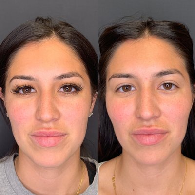 Cheek Boost - Many people are bothered by the appearance of flat cheeks that lack structure and contour. Others find that their cheeks lose volume with age and wish to regain the familiar appearance they had in their youth. Dermal fillers can be used to add the desired volume and lift without surgery.

Regardless of whether low cheek volume is caused by genetics, aging, disease, or dietary factors, it can be treated with a series of facial injections that lift the cheeks and surrounding area. It’s important to get cheek filler done by an experienced professional to avoid pushing the eyes upwards causing a cat-like appearance.