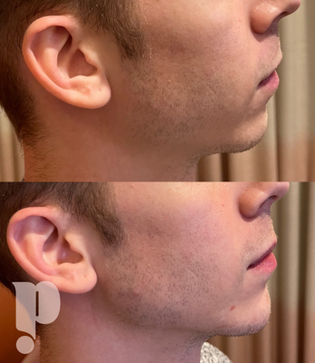 Chin And Jaw Filler - Starting at $700 per syringe with our Expert Injectors! Chin And Jaw Filler - Starting at $700 per syringe with our Expert Injectors!