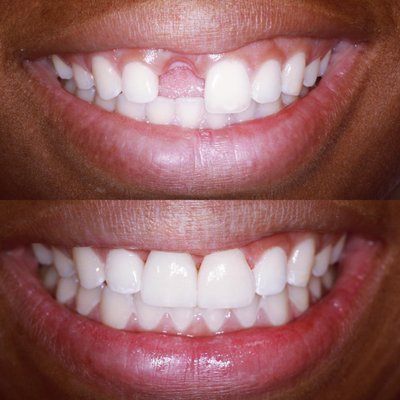 Before & After Photos - Check out some of our before & after cosmetic cases! Visit our website www.mccarldental.com to see more before and after photos, and to read more about our dentists and practice in Greenbelt, MD! Before & After Photos - Check out some of our before & after cosmetic cases! Visit our website www.mccarldental.com to see more before and after photos, and to read more about our dentists and practice in Greenbelt, MD!