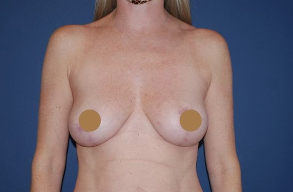 Breast Augmentation Without Implants - For patients solely interested in augmentation through fat grafting and who prefer to avoid implants
Autologous Fat Grafting (AFT) harvests fat from stubborn areas through liposuction and transfers it to the breasts. Common donor sites include the abdomen, thighs, and flanks. The purified fat is injected into the breasts to enhance volume and shape.