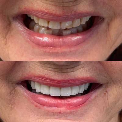 Veneers - Transforming average smiles to beautiful, winning smiles in just 2 visits. Dr. Beshoy Eskandar of The Smile Shapers is specialized in creating beautiful, dazzlling smiles..
With our hi tech state-of- the- art dental office we are able to offer excellent care to all our patients. Our services include all dental cosmetic procedures such as porcelain veneers, teeth whitening, cosmetic bonding, non- metal crowns, implants, bridges, fillings and partial dentures etc.
General dental procedures such as: preventative sealants, fluorides, teeth cleaning,non- surgical periodontal cleanings, root canal therapy, dentures and implant overdentures, extractions, snoreguards, niteguards, same day crowns, etc Veneers - Transforming average smiles to beautiful, winning smiles in just 2 visits. Dr. Beshoy Eskandar of The Smile Shapers is specialized in creating beautiful, dazzlling smiles..
With our hi tech state-of- the- art dental office we are able to offer excellent care to all our patients. Our services include all dental cosmetic procedures such as porcelain veneers, teeth whitening, cosmetic bonding, non- metal crowns, implants, bridges, fillings and partial dentures etc.
General dental procedures such as: preventative sealants, fluorides, teeth cleaning,non- surgical periodontal cleanings, root canal therapy, dentures and implant overdentures, extractions, snoreguards, niteguards, same day crowns, etc
