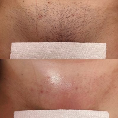 ✨ Brazilian ✨ - ✨ BRAZILIAN ✨
ALL hair will be removed from front and back. Using SUGAR wax!
Sugar Waxing is an organic hair removal method.
It is best for ALL skin types.
Works VERY well for for clients with sensitive skin.
Benefits of sugar waxing?
Less painful for MOST clients
Less growth overtime
Hair becomes thinner over time
Little to NO irritation
Will never experience being burnt by sugar wax
Organic and chemical free hair removal
Sugar wax consists of: Lemon, Water and Sugar. ✨ Brazilian ✨ - ✨ BRAZILIAN ✨
ALL hair will be removed from front and back. Using SUGAR wax!
Sugar Waxing is an organic hair removal method.
It is best for ALL skin types.
Works VERY well for for clients with sensitive skin.
Benefits of sugar waxing?
Less painful for MOST clients
Less growth overtime
Hair becomes thinner over time
Little to NO irritation
Will never experience being burnt by sugar wax
Organic and chemical free hair removal
Sugar wax consists of: Lemon, Water and Sugar.