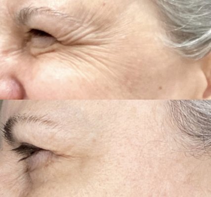 Botox Before and After - Check out these incredible instant results. A Botox transformation.