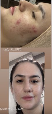 Before & After - Here you could see Before and after facial pictures.
Some of the pictures are shown with a few months of time span to show results, and some right after certain treatment such as Dermaplanning, series of Chemical peel, series of Microcurrent, Guasha and more. Before & After - Here you could see Before and after facial pictures.
Some of the pictures are shown with a few months of time span to show results, and some right after certain treatment such as Dermaplanning, series of Chemical peel, series of Microcurrent, Guasha and more.