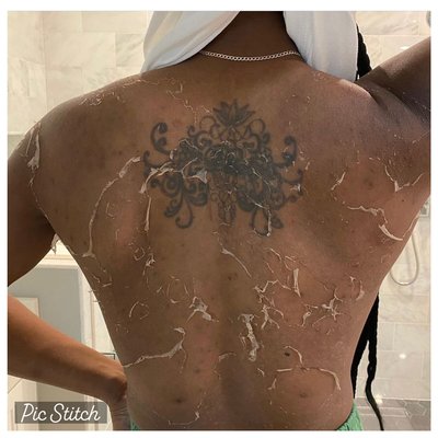 Body Back Peel - Chemical Peel on a client who suffered with back acne, scarring/hyperpigmentation. Body Back Peel - Chemical Peel on a client who suffered with back acne, scarring/hyperpigmentation.