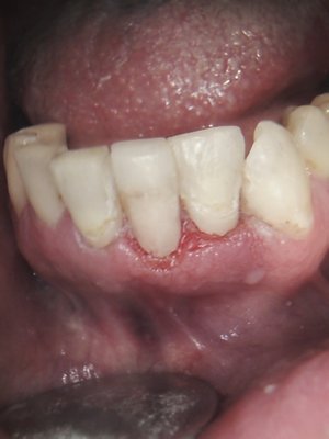 A quick repair with bonded composite - This case was a gentleman who was leaving town in a few days for a wedding and wanted to look better. The bonded composite approach was fast and gave a pretty good result. Ultimately these teeth will need crowns, but the patient's goal here was speed and this case was done in about an hour. A quick repair with bonded composite - This case was a gentleman who was leaving town in a few days for a wedding and wanted to look better. The bonded composite approach was fast and gave a pretty good result. Ultimately these teeth will need crowns, but the patient's goal here was speed and this case was done in about an hour.