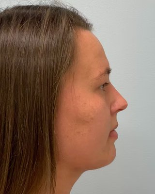 Chin & Neck Liposuction - Chin and neck liposuction by Dr. Gavin Dry. 27 year old female patient. Post-op images were captured at 6 months. Chin & Neck Liposuction - Chin and neck liposuction by Dr. Gavin Dry. 27 year old female patient. Post-op images were captured at 6 months.