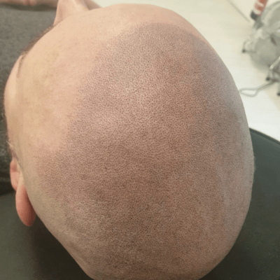 Scalp Micro pigmentation for Hair Loss - Call today to book your consult- 323 400 3595
We can solve your hair loss problems with our permanent, affordable solution. Our expert will discuss through your options. Scalp Micro pigmentation for Hair Loss - Call today to book your consult- 323 400 3595
We can solve your hair loss problems with our permanent, affordable solution. Our expert will discuss through your options.