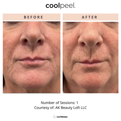 CO 2 Laser - CO2 lasers are the gold standard in treating wrinkles, age spots, acne scars, and other blemishes as well as tighten skin and balance tone. Damaged skin tissue is removed, or ablated, stimulating new collagen production and heat energy is delivered to tighten skin. Many advances have been made to improve the side effects of CO2 treatments. There is minimal risk of hyperpigmentation, demarcation or induced infection. The Tetra delivers high energy in extremely short pulses to deliver impressive resurfacing without lingering heat that would traditionally damage surrounding skin. Get immediate aesthetic effect with minimal downtime. CO 2 Laser - CO2 lasers are the gold standard in treating wrinkles, age spots, acne scars, and other blemishes as well as tighten skin and balance tone. Damaged skin tissue is removed, or ablated, stimulating new collagen production and heat energy is delivered to tighten skin. Many advances have been made to improve the side effects of CO2 treatments. There is minimal risk of hyperpigmentation, demarcation or induced infection. The Tetra delivers high energy in extremely short pulses to deliver impressive resurfacing without lingering heat that would traditionally damage surrounding skin. Get immediate aesthetic effect with minimal downtime.