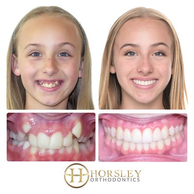 Horsley Smiles - At Horsley Orthodontics, we go beyond straight teeth—we create beautifully balanced, confident smiles. Our expert care focuses on designing the perfect smile arc, ensuring a natural and radiant look. We meticulously align midlines for facial harmony, craft broad smiles that enhance aesthetics, and refine gum tissue for an even, polished appearance. The result? A stunning, healthy Horsley Smile tailored just for you. Horsley Smiles - At Horsley Orthodontics, we go beyond straight teeth—we create beautifully balanced, confident smiles. Our expert care focuses on designing the perfect smile arc, ensuring a natural and radiant look. We meticulously align midlines for facial harmony, craft broad smiles that enhance aesthetics, and refine gum tissue for an even, polished appearance. The result? A stunning, healthy Horsley Smile tailored just for you.