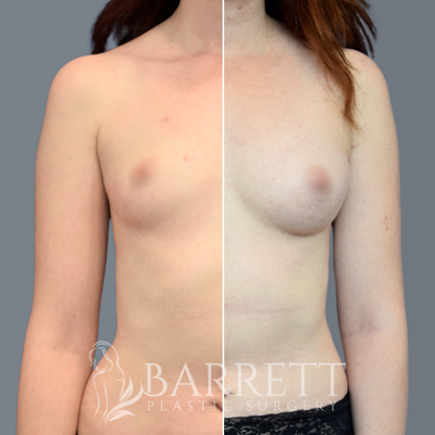 Fat Transfer To Breast - Fat transfer to breasts is a two-step surgical procedure that removes excess fat from one area of the body and transfers it to the breasts to increase the breast size and shape naturally. We use the revolutionary S.A.F.E. liposuction technique to preserve the maximum amount of fat cells to achieve optimal results. Breast augmentation with fat grafting is an excellent option for many women who want to slightly enhance the shape and size of their breasts without implants. Often used for cosmetic purposes, particularly to achieve upper pole fullness, this technique is also performed for medical purposes during breast reconstruction or correction.

A fat transfer to breasts typically increases the breast size by approximately one-half cup size. Patients seeking a more considerable size increase may need to undergo multiple fat grafting procedures or combine with implants to achieve their desired result. During your initial consultation, your surgeon will provide a comprehensive exam and discuss your goals to understand if this procedure is correct for you. Dr. Barrett is a world renowned board-certified plastic surgeon in Beverly Hills, California. He specializes in aesthetic and reconstructive surgery of the face, breast, and body.