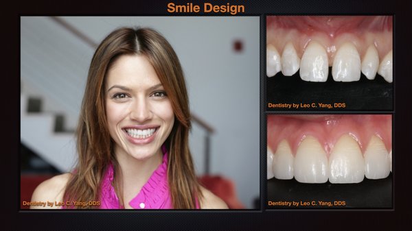 Same Day Smile - Are you looking for a new Smile!  For customers who are happy with your smile and want a change using porcelain veneers/crowns technique, we have a unique way of achieving your goals in the Same Day, hence Same Day Smile!

Please call us at 415-383-1737 or email us at info@millvalleydentist.com for a consultation to see if this is the right treatment for you.