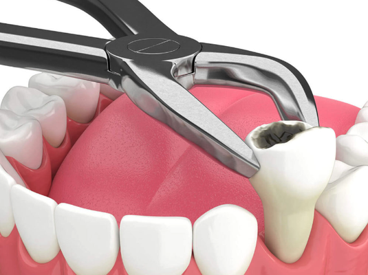 $99 Simple Tooth Extractions - At Affinity Dental Center, we understand that no one likes the idea of having a tooth extracted. Still, in some cases, it becomes necessary to protect your overall oral health. Whether the cause is an impacted wisdom tooth, an extensively decayed tooth, or a tooth fractured beyond repair, our experienced dental team is here to guide you through the process with utmost care and expertise.
We pride ourselves in making tooth extraction as comfortable and worry-free as possible. Our meticulous pre-procedure planning involves detailed examination and use of modern imaging techniques to anticipate and address potential issues. This proactive approach contributes to our commitment towards a safe tooth extraction every time.
Once the extraction is complete, we prioritize getting you back on track to normal as soon as possible. Each step of our post-extraction care is designed to promote quick recovery. To minimize swelling, discomfort, and potential complications, we provide comprehensive aftercare instructions and support.
Your well-being and comfort throughout the extraction and recovery process are our top priority. We stay available for any post-procedure queries or concerns, ensuring that our patients receive first-rate care even after leaving our clinic.
Choose Affinity Dental Center for your tooth extraction needs. We provide a safe environment, an experienced team and a recovery-focused approach, placing you on the fast track to regaining your brilliant, healthy smile. $99 Simple Tooth Extractions - At Affinity Dental Center, we understand that no one likes the idea of having a tooth extracted. Still, in some cases, it becomes necessary to protect your overall oral health. Whether the cause is an impacted wisdom tooth, an extensively decayed tooth, or a tooth fractured beyond repair, our experienced dental team is here to guide you through the process with utmost care and expertise.
We pride ourselves in making tooth extraction as comfortable and worry-free as possible. Our meticulous pre-procedure planning involves detailed examination and use of modern imaging techniques to anticipate and address potential issues. This proactive approach contributes to our commitment towards a safe tooth extraction every time.
Once the extraction is complete, we prioritize getting you back on track to normal as soon as possible. Each step of our post-extraction care is designed to promote quick recovery. To minimize swelling, discomfort, and potential complications, we provide comprehensive aftercare instructions and support.
Your well-being and comfort throughout the extraction and recovery process are our top priority. We stay available for any post-procedure queries or concerns, ensuring that our patients receive first-rate care even after leaving our clinic.
Choose Affinity Dental Center for your tooth extraction needs. We provide a safe environment, an experienced team and a recovery-focused approach, placing you on the fast track to regaining your brilliant, healthy smile.