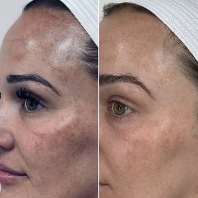Facial Discoloration Solutions that Work - Check out the dramatic reduction in these client's hyperpigmentation! Talk about transformation! For the best results I choose a series of PCA Skin Pigment Correct Peel + 4% Retinol Peel spaced 4-6 week apart in combination with an at-home routine using Vitamin B3 Brightening Serum and Pigment Correct Peel for six months. Facial Discoloration Solutions that Work - Check out the dramatic reduction in these client's hyperpigmentation! Talk about transformation! For the best results I choose a series of PCA Skin Pigment Correct Peel + 4% Retinol Peel spaced 4-6 week apart in combination with an at-home routine using Vitamin B3 Brightening Serum and Pigment Correct Peel for six months.