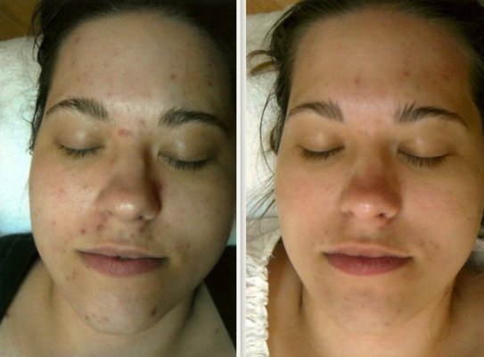 Microdermabration and Facials - Microdermabrasion is a minimally invasive procedure used to renew overall skin tone and texture. It can help improve the appearance of skin affected by sun exposure, wrinkles, acne, and other conditions. The procedure uses a special applicator with abrasive surface to gently sand away the thick outer layer of the skin to rejuvenate it.  The Procedure takes approximately 60mins. We offer multiple skin treatments including dermaplaning, chemical peels and more. 

Feel free to check out our website. We can also offer you free consultations over video calls.