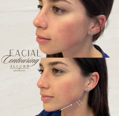 Facial Rejuvenation - At Allure Aesthetics, we specialize in sophisticated facial rejuvenation designed to enhance your natural beauty with elegance and precision. Our portfolio features an array of filler treatments, from jawline sculpting and chin enhancements to personalized facial balancing, each tailored to harmonize and refine your unique features. Delivered in a serene, upscale environment, every treatment combines artistry with advanced techniques, leaving you with results that are timeless, confident, and radiant. Facial Rejuvenation - At Allure Aesthetics, we specialize in sophisticated facial rejuvenation designed to enhance your natural beauty with elegance and precision. Our portfolio features an array of filler treatments, from jawline sculpting and chin enhancements to personalized facial balancing, each tailored to harmonize and refine your unique features. Delivered in a serene, upscale environment, every treatment combines artistry with advanced techniques, leaving you with results that are timeless, confident, and radiant.