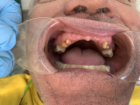 Full Upper Makeover - Patient needed a combination of crowns, bridge and implants to restore his smile. Full Upper Makeover - Patient needed a combination of crowns, bridge and implants to restore his smile.