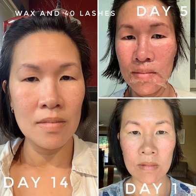 Chemical Peel - WHAT IS PEELING? Peeling means what it says, the peeling of the skin. There are a number 
of different methods and procedures which may cause the skin to peel. You can get the skin to peel by rubbing it with liquid nitrogen, by applying acids to it in various concentrations or by exposing it to ultra violet rays or sun lamps, creating skin peeling after sunburn. Continued 
exposure to the sun’s damaging rays as well as sun beds, increasing your risk of potentially deadly skin cancers. Some acids will destroy the 
epidermal cells including both the horny cells and if the acid concentration is high, even the sub-horny cells. Skin peeling was invented and perfected in 1882 by the German dermatologist, Unna. Not all the best techniques have been developed in the last 20 years! 
Unna describes his method of peeling as “exfoliation” a word which should be retained for it describes what takes place and helps to distinguish this method of peeling from others. The 
special characteristic of exfoliation of “The Skin Renewal Peelings” is that no destruction of the cells is involved. Cells in the horny layer detach from the skin but are not destroyed.  Sloughing off the dead skin is 
far from being the most important occurrence that happens during peeling.
The reason that peeling is effective is not because it causes the skin to peel. The effects of exfoliation are found deep in the epidermis and in the 
dermis, leading to the formation of new collagen and elastin.