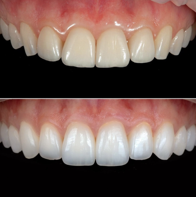 Crowns - Crown Cases Crowns - Crown Cases
