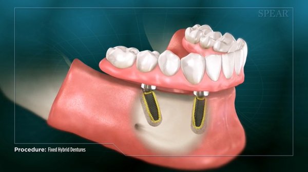 ALL ON 4 - Dental Implant supported Bridge - We provide All on 4 dental implants options. Utilizing angled implants we can offer a permanently seated full arch denture so you can chew, speak, and smile like you have normal teeth. If you would like to know more, setup a consultation with Dr. Ray and he can explain the process.