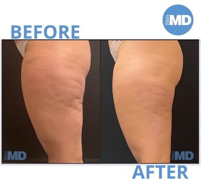 Morpheus - Morpheus8: Advanced Microneedling with Radiofrequency
Morpheus8 is a cutting-edge, non-surgical treatment designed to lift, tighten, and contour the skin by targeting deep layers of tissue. As the first and only full-body subdermal adipose remodeling device, Morpheus8 goes beyond traditional microneedling by combining radiofrequency (RF) energy to stimulate collagen and elastin production—effectively remodeling and rejuvenating from the inside out.
This powerful treatment can help improve:
Loose or sagging skin on the face, jawline, neck, and body
Wrinkles and fine lines on the face, neck, and décolletage
Under-eye bags, sagging, and fine lines
Acne scars and uneven texture
Stretch marks and discoloration
Crepey skin on arms, knees, and abdomen
With minimal downtime and long-lasting results, Morpheus8 is ideal for anyone seeking a firmer, smoother, and more youthful appearance—without surgery. Morpheus - Morpheus8: Advanced Microneedling with Radiofrequency
Morpheus8 is a cutting-edge, non-surgical treatment designed to lift, tighten, and contour the skin by targeting deep layers of tissue. As the first and only full-body subdermal adipose remodeling device, Morpheus8 goes beyond traditional microneedling by combining radiofrequency (RF) energy to stimulate collagen and elastin production—effectively remodeling and rejuvenating from the inside out.
This powerful treatment can help improve:
Loose or sagging skin on the face, jawline, neck, and body
Wrinkles and fine lines on the face, neck, and décolletage
Under-eye bags, sagging, and fine lines
Acne scars and uneven texture
Stretch marks and discoloration
Crepey skin on arms, knees, and abdomen
With minimal downtime and long-lasting results, Morpheus8 is ideal for anyone seeking a firmer, smoother, and more youthful appearance—without surgery.
