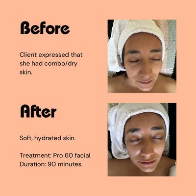 Portfolio - This fully customizable facial treatment includes a double cleanse, resurfacing treatment, extractions, massage, deep treatment, plus dermal layering; All using Dermalogica products! Portfolio - This fully customizable facial treatment includes a double cleanse, resurfacing treatment, extractions, massage, deep treatment, plus dermal layering; All using Dermalogica products!