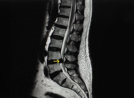 Herniated Disc - The Cox flexion-distraction procedure can be used to help address herniated disc symptoms. This requires a specialized table to gently "distract" or stretch the spine. This isolates the affected area while slightly "flexing" the spine. This can help to move the disc away from the nerve. I have been using Cox flexion-distraction in my office for over 15 year and it is a great way to manage conservative back pain.
We are a chiropractic and acupuncture office that has 35 years of experience. We specialize in acute and chronic pain management. We help with herniated discs, scoliosis, back pain, subluxations, arthritis, sciatica, kyphosis, frozen shoulder, golfer's elbow, bone spurs, acid reflux, gut health and much more.
We are accepting new patients. Call us to schedule your an appointment today! Herniated Disc - The Cox flexion-distraction procedure can be used to help address herniated disc symptoms. This requires a specialized table to gently "distract" or stretch the spine. This isolates the affected area while slightly "flexing" the spine. This can help to move the disc away from the nerve. I have been using Cox flexion-distraction in my office for over 15 year and it is a great way to manage conservative back pain.
We are a chiropractic and acupuncture office that has 35 years of experience. We specialize in acute and chronic pain management. We help with herniated discs, scoliosis, back pain, subluxations, arthritis, sciatica, kyphosis, frozen shoulder, golfer's elbow, bone spurs, acid reflux, gut health and much more.
We are accepting new patients. Call us to schedule your an appointment today!