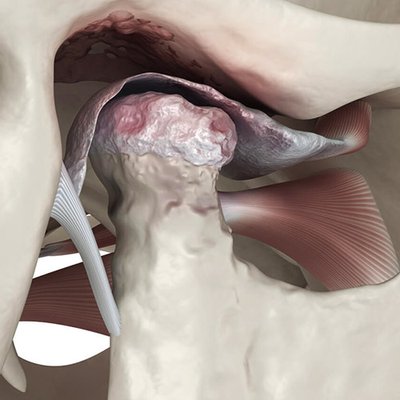 TMJ/TMJD - TMJD (also just called TMJ), is a disorder of the temporomandibular joint in your jaw. The condition frequently causes pain in the jaw, neck, face, or shoulders – and even the back, hips, legs, and feet. It can also cause symptoms like migraines, ringing in the ears, and jaw clicking. TMJ/TMJD - TMJD (also just called TMJ), is a disorder of the temporomandibular joint in your jaw. The condition frequently causes pain in the jaw, neck, face, or shoulders – and even the back, hips, legs, and feet. It can also cause symptoms like migraines, ringing in the ears, and jaw clicking.