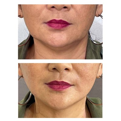 Neck and Body Sculpting - Aging is a natural phenomenon that you can’t avoid. As you get older, your body’s ability to defend, maintain, and repair itself is less efficient, which leads to the many issues associated with aging. At Resplendence MedSpa in Beverly Hills, California, Majid Sabour, MD, and the aesthetic experts take a holistic approach to health and wellness. At the Los Angeles medical spa, they offer many anti-aging treatments to help you feel and look younger. Call the office or book your anti-aging consultation online today. Neck and Body Sculpting - Aging is a natural phenomenon that you can’t avoid. As you get older, your body’s ability to defend, maintain, and repair itself is less efficient, which leads to the many issues associated with aging. At Resplendence MedSpa in Beverly Hills, California, Majid Sabour, MD, and the aesthetic experts take a holistic approach to health and wellness. At the Los Angeles medical spa, they offer many anti-aging treatments to help you feel and look younger. Call the office or book your anti-aging consultation online today.