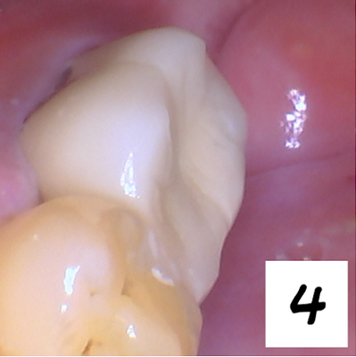 Dental Crown Procedure - Step by step photo for a Dental crown procedure. Dental Crown Procedure - Step by step photo for a Dental crown procedure.