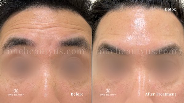 Botox - Botox is a medication injected into muscles in order to temporarily smooth crow's-feet around the eyes and frown lines and other lines on the forehead. It contains a highly purified botulinum-toxin protein. Botox - Botox is a medication injected into muscles in order to temporarily smooth crow's-feet around the eyes and frown lines and other lines on the forehead. It contains a highly purified botulinum-toxin protein.