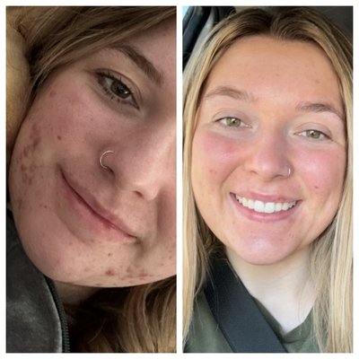 Getting acne under control. - Acne is a beast, but with some commitment it can be controlled. Both these beauties came in monthly for facials but mostly chemical peels… we needed to cut through some layers of dead skin that was blocking the pores from breathing. They both stayed on the home care I suggested.. they got good results!