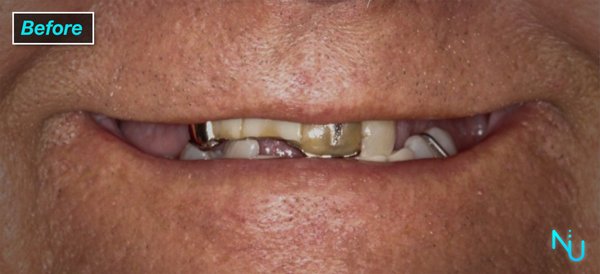 Implant Supported Dentures - Before and After Images of Implant Supported Dentures Placed at Nu Dentistry.