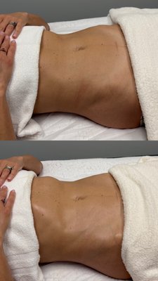 Brazilian Lymphatic Drainage - Brazilian Lymphatic Drainage at Prestige Aesthetics

Feel lighter, unwind, and enjoy personalized body care at Prestige Aesthetics. Our Brazilian Lymphatic Drainage massage combines rhythmic movements and carefully tailored pressure in a relaxing experience designed around your comfort and goals.

Founded by Naira, a licensed aesthetician, massage therapist, and certified Brazilian Lymphatic Drainage specialist, Prestige Aesthetics offers thoughtful, hands-on care for women in Burlingame and San Rafael, Marin County.

WHAT IS BRAZILIAN LYMPHATIC DRAINAGE?

Brazilian Lymphatic Drainage is a specialized massage technique that works with the body’s lymphatic pathways. It combines flowing strokes, rhythmic pumping movements, and targeted massage to encourage fluid movement and create a feeling of lightness and relaxation.

Clients often seek this treatment when they feel puffy, heavy, or uncomfortable from everyday fluid retention. Some notice a temporarily smoother, more defined appearance after a session. Every body responds differently, and the experience is customized to each client.

YOUR SESSION, PERSONALIZED

Your appointment begins with a conversation about your goals, health history, and comfort level. We tailor the session to your needs, with attention to areas such as the legs, arms, abdomen, and back when appropriate.

Select longer sessions can also include facial lymphatic massage, adding a soothing finishing touch to your treatment. Pressure is adjusted throughout your appointment, and we welcome your feedback so you can feel comfortable and cared for.

Whether you are scheduling your first lymphatic massage or making time for regular self-care, our approach is attentive, professional, and personal.

WHY CLIENTS CHOOSE PRESTIGE AESTHETICS

• Care from a trained Brazilian Lymphatic Drainage specialist
• Personalized sessions based on your needs and comfort
• A welcoming practice dedicated to women
• Attention to detail and an unhurried treatment experience
• Convenient locations in Burlingame and San Rafael
• Easy online booking through Vagaro

We believe that beautiful care begins with listening. Our goal is to help you leave feeling relaxed, refreshed, and more comfortable in your body.

POST-OPERATIVE LYMPHATIC CARE

We also offer separate post-operative lymphatic appointments for clients recovering from cosmetic surgery. These sessions are tailored to the procedure, stage of recovery, and surgeon’s instructions. Surgeon clearance is required before treatment.

If you are booking after surgery, please choose our post-operative service and contact us before your appointment so we can discuss your needs.

WHAT TO EXPECT

Lymphatic massage is a hands-on treatment. It is not a weight-loss procedure, and changes related to fluid retention may be temporary. Results vary based on your body, health, and individual circumstances.

Certain medical conditions may make lymphatic massage unsuitable or require medical clearance. Please share relevant health information when booking, including recent surgery, pregnancy, or any ongoing medical concerns.

BOOK YOUR MOMENT OF SELF-CARE

Discover a personalized Brazilian Lymphatic Drainage experience at Prestige Aesthetics. Whether your goal is relaxation, a feeling of lightness, or a thoughtful addition to your wellness routine, we look forward to welcoming you.

Serving women in Burlingame, San Rafael, Marin County, and the surrounding Bay Area.

Book your appointment through Vagaro.