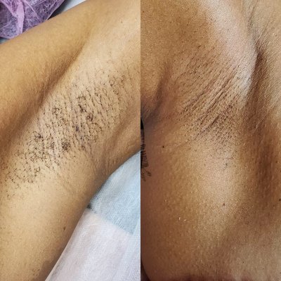 Eyelash Extensions and Skincare - Before and After of underarm wax as well as completed look of eyelash extensions from classic too volume.