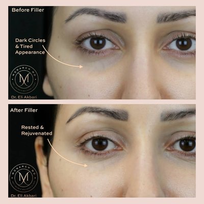 Under Eye Filler - Under eye filler with before and after results. Under Eye Filler - Under eye filler with before and after results.