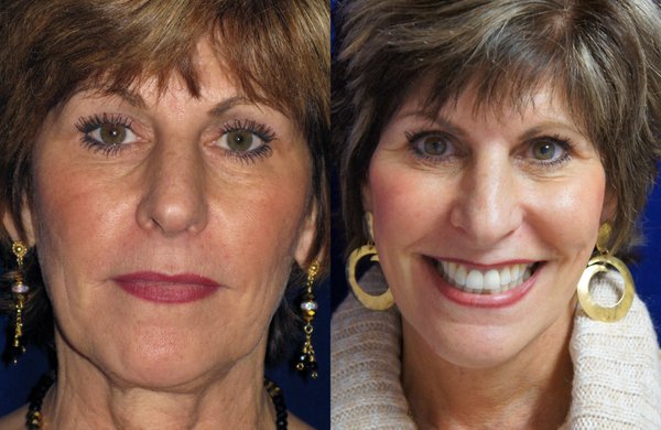 Facelifts - A facelift makes the cheeks and neck more youthful and more attractive.  As we age, our skin stretches and loses its elasticity. A facelift reverses these occurrences of aging.  I elevate and pull the skin and fat back to a youthful position. The excess skin and fat are then removed.