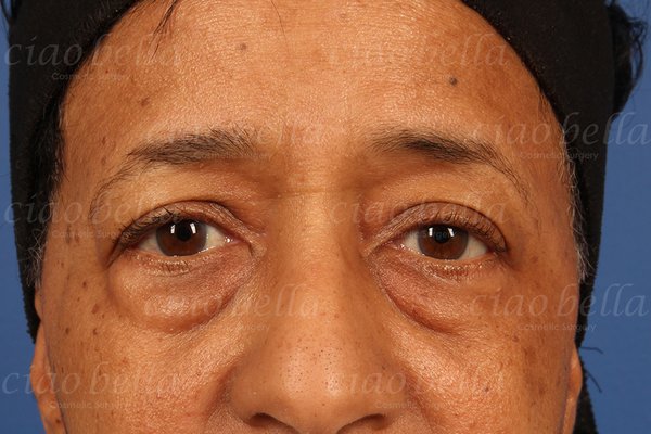 Eyelid (Blepharoplasty) - Bags under the eyes and or droopy eyelids can cause people to look tired and older than they really are. People often loose volume under the eyes with age or because of other factors such as stress, lack of sleep, etc. Droopy eyelids are not as common as bags but can be more bothersome. The good news is that now we can easily correct bags or droopy eyelids in most cases in less than 30 minutes. With the use of injectable fillers the doctor can easily add volume back to bags under the eyes or above the eyelid. This procedure is painless and patients return to normal activities immediately after. Eyelid (Blepharoplasty) - Bags under the eyes and or droopy eyelids can cause people to look tired and older than they really are. People often loose volume under the eyes with age or because of other factors such as stress, lack of sleep, etc. Droopy eyelids are not as common as bags but can be more bothersome. The good news is that now we can easily correct bags or droopy eyelids in most cases in less than 30 minutes. With the use of injectable fillers the doctor can easily add volume back to bags under the eyes or above the eyelid. This procedure is painless and patients return to normal activities immediately after.