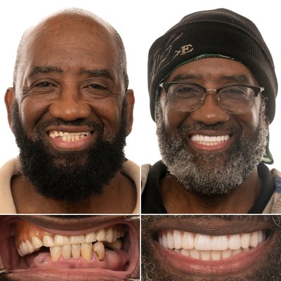 Eddie’s Journey to a New Smile with Dental Implants - After wearing a denture for nearly a decade, Eddie came to JAX Implants looking for a long-term solution for tooth replacement. He wanted something that would allow him to eat, speak, and smile with confidence. With dental implants, Eddie now enjoys a secure, natural-looking smile and the freedom to live without worry. Eddie’s Journey to a New Smile with Dental Implants - After wearing a denture for nearly a decade, Eddie came to JAX Implants looking for a long-term solution for tooth replacement. He wanted something that would allow him to eat, speak, and smile with confidence. With dental implants, Eddie now enjoys a secure, natural-looking smile and the freedom to live without worry.
