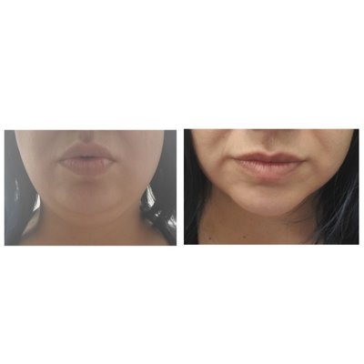 Cryoslimming on double chin OR Cryofacial - Receive an immediate and on going result from enjoying a Cryoslimming on the double chin or Cryofacial for only $150! (REGULARLY $599/$399! Cryoslimming on double chin OR Cryofacial - Receive an immediate and on going result from enjoying a Cryoslimming on the double chin or Cryofacial for only $150! (REGULARLY $599/$399!