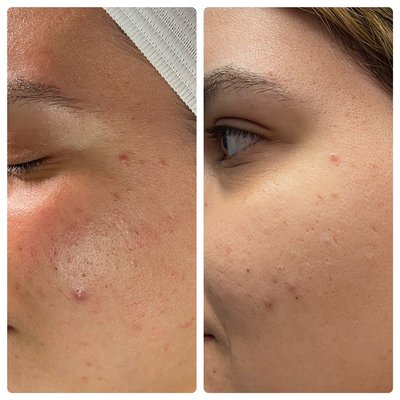 Chemical Peels: Before & After - Chemical Peels Before & After - We use medical grade chemical peels by GlymedPlus and PCA Skin. Consultation is required prior to treatment to ensure safety and efficacy.