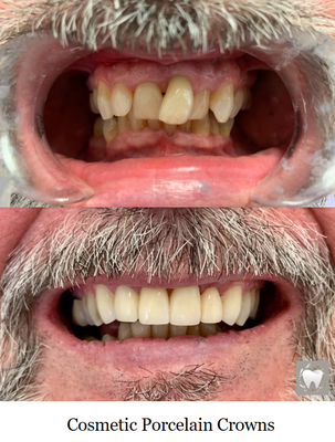 Transform Your Smile with Cosmetic Porcelain Crowns - This case included 7 Cosmetic Porcelain Crowns Transform Your Smile with Cosmetic Porcelain Crowns - This case included 7 Cosmetic Porcelain Crowns