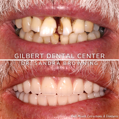 Dentures - Dentures can be an affordable way to makeover your smile. Whether it includes full mouth extractions, or if it is replacing an older pair of Dentures, Gilbert Dental Center can help you create a smile that you love! Dentures - Dentures can be an affordable way to makeover your smile. Whether it includes full mouth extractions, or if it is replacing an older pair of Dentures, Gilbert Dental Center can help you create a smile that you love!