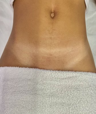 Brazilians and Intimate Care - Brazilian Sugaring is less painful than traditional waxing. Sugaring is all natural and organic. Sugar paste is made from: water, lemon, and sugar. No more ingrown hairs, razor bumps, red skin, or toxic chemicals. Sugaring is safe, natural, effective, and leads to refinement overtime. Sugaring is perfect for anyone who has sensitive skin, is prone to ingrowns, or just wants a 100% natural alternative to wax! You’ll never want to wax again! Brazilians last 4-6 weeks.