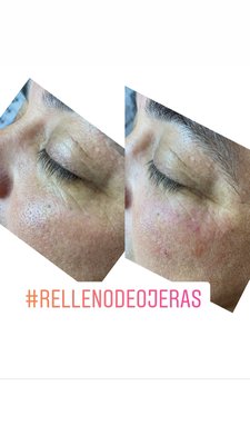 Hydrafacial - HydraFacial uses patented technology to cleanse, extract, and hydrate. HydraFacial super serums are made with nourishing ingredients that create an instantly gratifying glow. We begin with a deep cleanse, light chemical peel, and extractions, then finish the treatment with a customized booster serum and antioxidant infused moisturizer.
