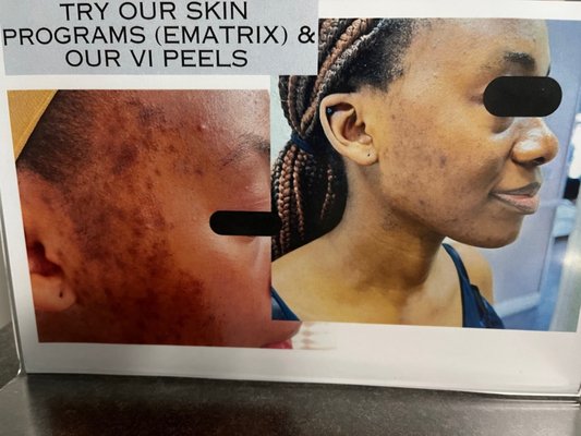 Radio Frequency and Light Skin Program - Laser Essentials Skin Program has to be one of the best in the industry! We do the following:
6 (six) Laser facial treatments, 3 (three) Exmatrix/Sublative treatments, 3 (three) Steam Facials and 3 (three) Glycolic Acid Peels! ALL FOR ONLY $1,699!!!!
Note: You can opted out a Ematrix for a Vi Peel too! (Flexible)