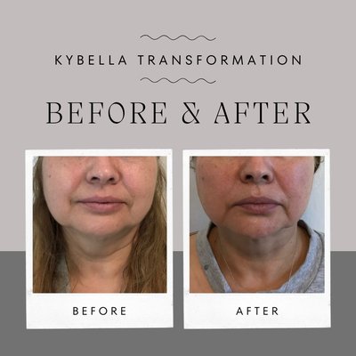 Kybella - KYBELLA® is the only FDA-approved injectable treatment that destroys fat cells in the treatment area under the chin to improve your profile. The active ingredient in KYBELLA® is synthetic deoxycholic acid. Deoxycholic acid is a naturally occurring molecule in the body that aids in the breakdown and absorption of dietary fat. When injected into the fat beneath the chin, KYBELLA® destroys fat cells, resulting in a noticeable reduction in fullness under the chin. Once destroyed, these cells can no longer store or accumulate fat, so further treatment is not expected once you reach your desired aesthetic goal. Kybella - KYBELLA® is the only FDA-approved injectable treatment that destroys fat cells in the treatment area under the chin to improve your profile. The active ingredient in KYBELLA® is synthetic deoxycholic acid. Deoxycholic acid is a naturally occurring molecule in the body that aids in the breakdown and absorption of dietary fat. When injected into the fat beneath the chin, KYBELLA® destroys fat cells, resulting in a noticeable reduction in fullness under the chin. Once destroyed, these cells can no longer store or accumulate fat, so further treatment is not expected once you reach your desired aesthetic goal.