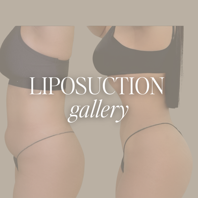 Liposuction - Specializing in Awake Liposuction, Dr. Jesus Beltran M.D. performs expert body contouring services at The Aesthetic Suite. Treatment options include Liposuction, Renuvion Skin Tightening, and Fat Transfer to areas such as the buttocks, breasts, and face. Liposuction can be performed in virtually any area of the body where stubborn fat persists. Common areas include the abdomen, flanks, back, arms, thighs, chin, and face. Patients are provided with an extensive pre and post care regimen under Dr. Jesus Beltran. Schedule a FREE consultation to receive an assessment, personalized quote, and an opportunity to ask any questions regarding Liposuction and similar services. Liposuction - Specializing in Awake Liposuction, Dr. Jesus Beltran M.D. performs expert body contouring services at The Aesthetic Suite. Treatment options include Liposuction, Renuvion Skin Tightening, and Fat Transfer to areas such as the buttocks, breasts, and face. Liposuction can be performed in virtually any area of the body where stubborn fat persists. Common areas include the abdomen, flanks, back, arms, thighs, chin, and face. Patients are provided with an extensive pre and post care regimen under Dr. Jesus Beltran. Schedule a FREE consultation to receive an assessment, personalized quote, and an opportunity to ask any questions regarding Liposuction and similar services.