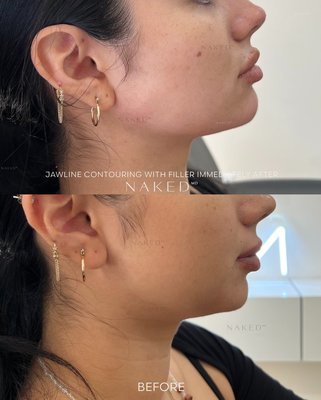 Jawline Contour Filler - For anyone wanting an elongated or “snatched” (tight and defined) look in their lower face. However, it does not completely eliminate the appearance of jowls, sagging skin or a double chin. Jawline fillers may help minimize these areas depending on severity. This treatment provides volume and creates a more defined separation between the jawline and the neck. It can give the face a sharper angle, strengthen or add proportion to the chin and provide a strong foundation and frame for the face. Although it is up to the injectors’ discretion, 4 syringes are used on average. For some patients, it is beneficial to get Neurotoxin injections to the masseters prior to jawline fillers to create a slimmer V-shape jawline. Jawline Contour Filler - For anyone wanting an elongated or “snatched” (tight and defined) look in their lower face. However, it does not completely eliminate the appearance of jowls, sagging skin or a double chin. Jawline fillers may help minimize these areas depending on severity. This treatment provides volume and creates a more defined separation between the jawline and the neck. It can give the face a sharper angle, strengthen or add proportion to the chin and provide a strong foundation and frame for the face. Although it is up to the injectors’ discretion, 4 syringes are used on average. For some patients, it is beneficial to get Neurotoxin injections to the masseters prior to jawline fillers to create a slimmer V-shape jawline.